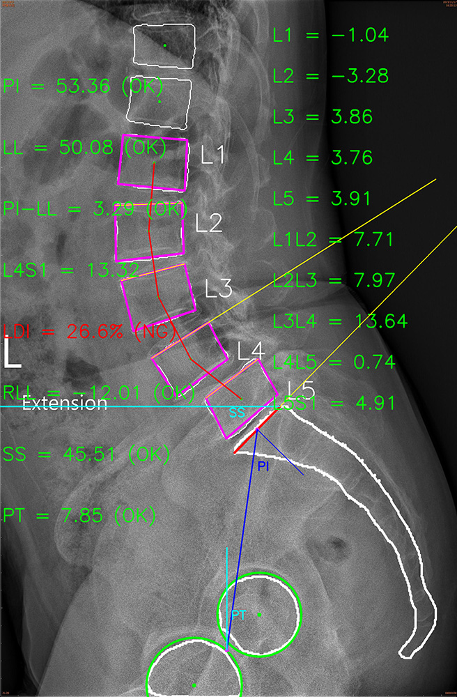 Measurement Technique for Lumbar Spine X-Ray Images reduces time and labor for lumbar spine X-ray interpretation.