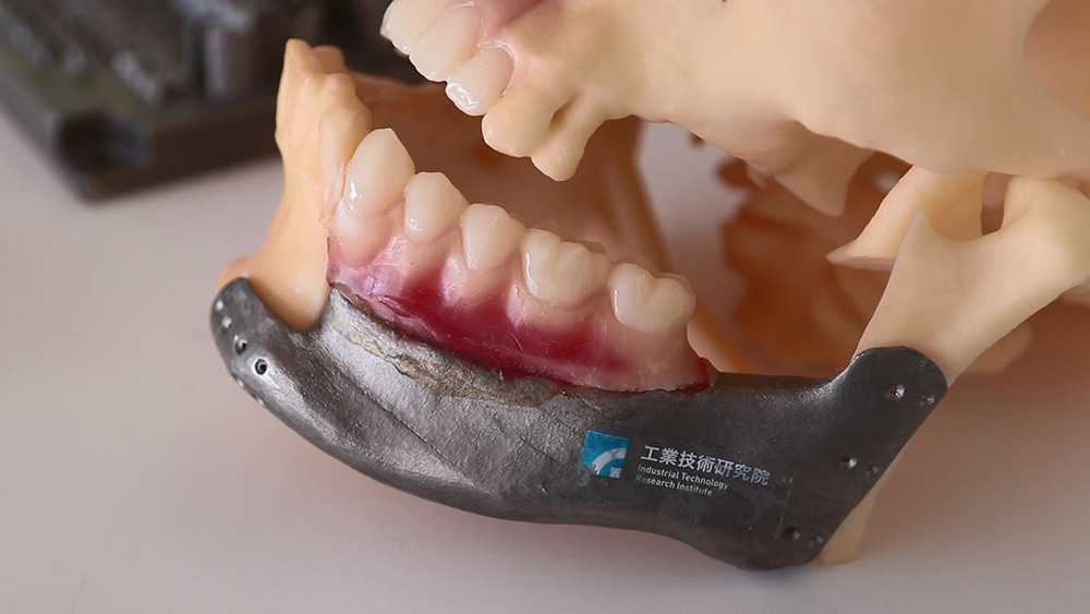 The 3D-printed prosthetic jaw co-developed by ITRI and KSVGH.